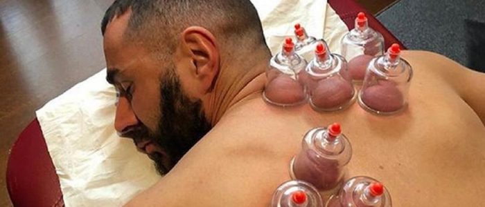 Foto Bekam Sunnah: Cara Praktikal & Faedah Kesihatan untuk Penyembuhan Semulajadi